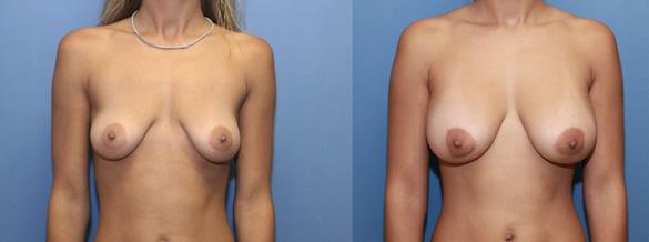Breast implants 350 cc silicone
